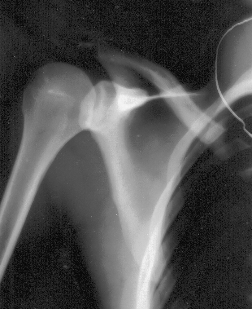 shoulder